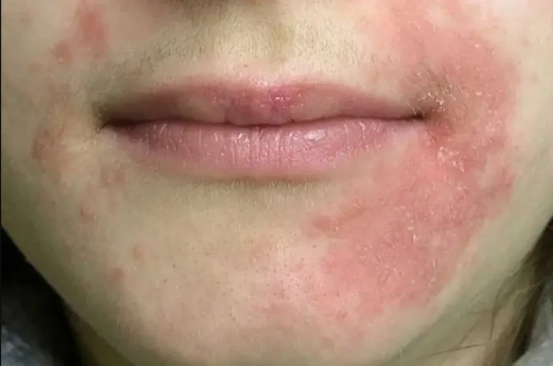 Người có da viêm, dễ dị ứng hoặc đang điều trị da liễu nên thận trọng trước khi triệt lông